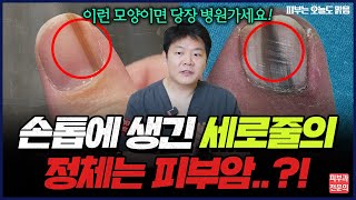 손톱에 생긴 검은 세로줄, 피부암일까? 피부과 의사가 알려주는 진짜 위험 신호