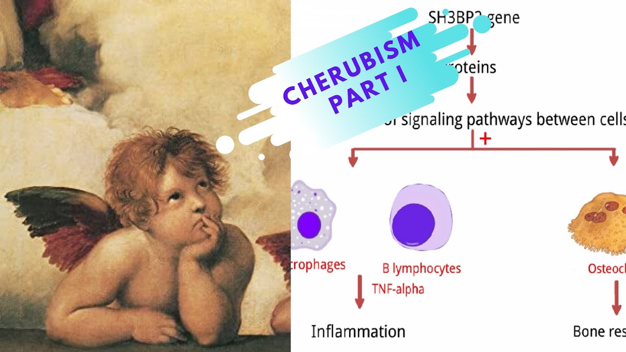 Cherubism Part 1 || Etiopathogenesis, Clinical features ...