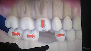Consequences of not replacing Missing teeth