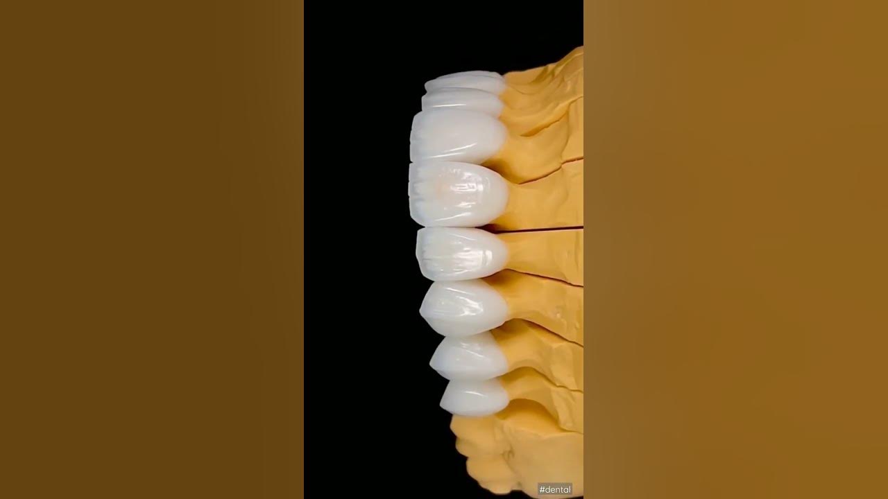 Porcelain Veneers in Colombia. YouTube