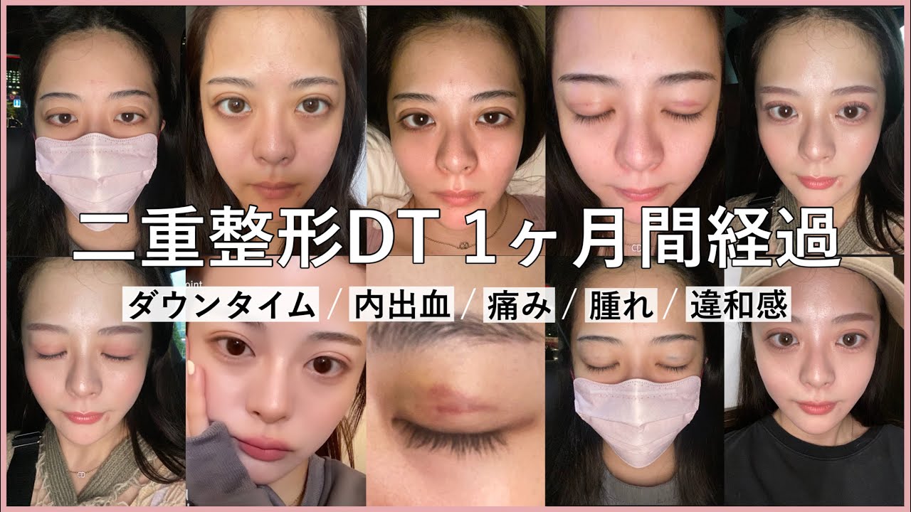【二重整形】ダウンタイム約1ヶ月間の経過記録。痛みや腫れなど､リアルな変化を全てお見せします！👁♡