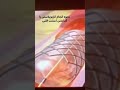 انژیوپلاستی یا تعبیه استنت قلبی دکتر فرنازخداپرست متخصص قلب وعروق Dr Farnazkhodaparast انژیوپلاستی یا تعبیه استنت قلبی دکتر فرنازخداپرست متخصص قلب وعروق Dr Farnazkhodaparast