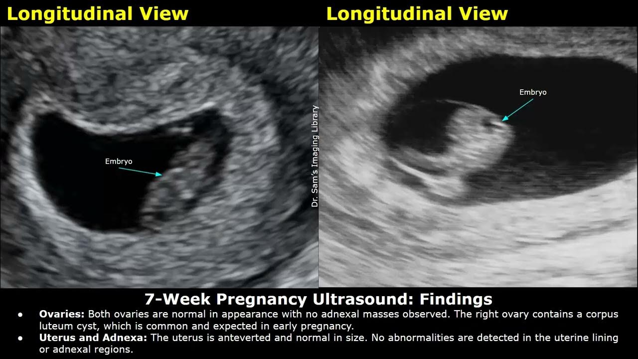 7-week-pregnancy-obstetric-ultrasound-report-example-normal