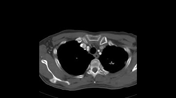 Intralobar sequestration (A) (Ahuja AT et al; 2017) Book: Essential Radiology