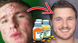 These Vitamins Are Proven To ELIMINATE Acne ??