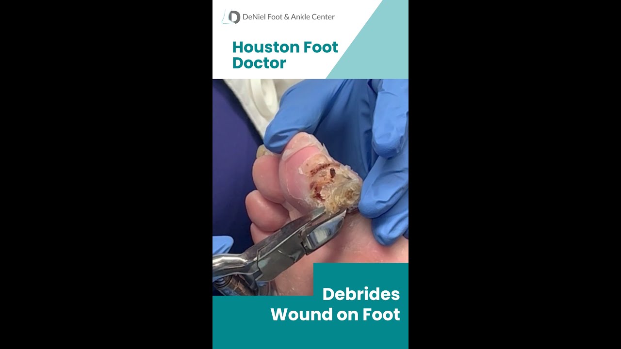 Wound Debridement by Houston Foot Doctor #woundcare #podiatrist #footdoctor