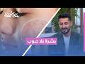 حب الشباب.. الدليل النهائي للحلول الفعالة بعيداً عن تجارب "المطبخ" الخطيرة! 🚫🧴 بشرة صافية في 2026.