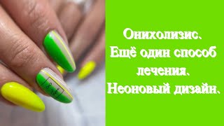 Онихолизис. Ещё один способ лечения. Неоновый дизайн.