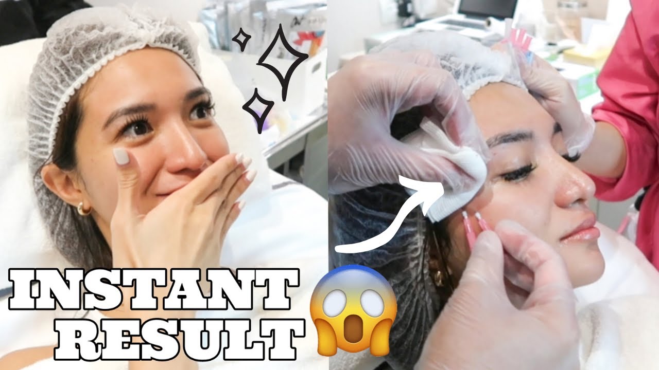 BELO Fox Eye & Fillers (everything you need to know!) | Angel Dei