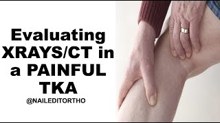 Evaluating Xrays and CT scans in a painful TKA