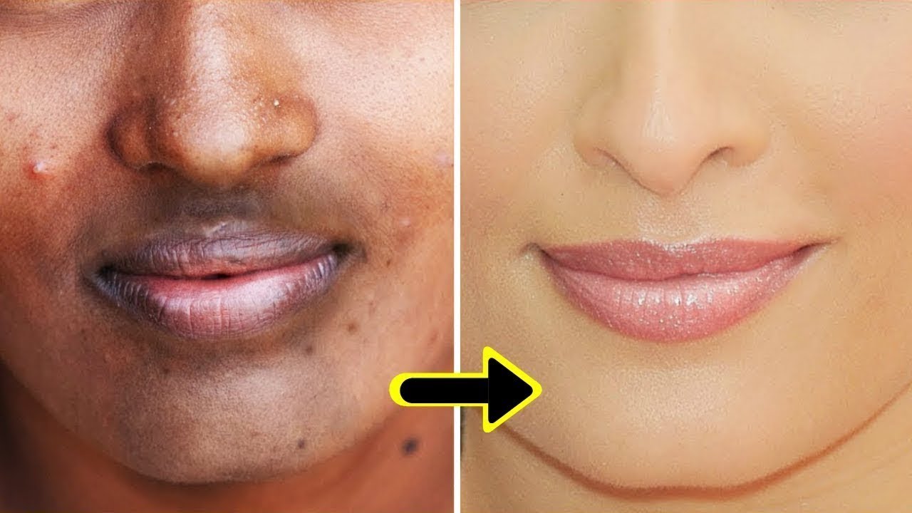 How To Remove Dark Black patches, Dark Spots,Hyper pigmentation, Around Your Mouth - YouTube