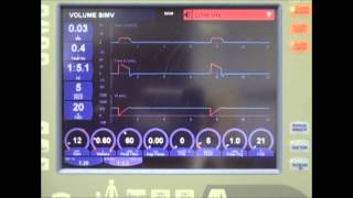 Viasys Avea Ventilator with Blom Tracheostomy Tube