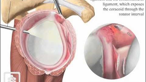 Arthroscopic capsular release for frozen shoulder.mov