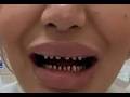 TURKEY TEETH COME TO UK