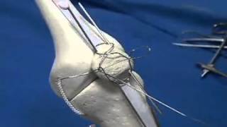 AO foundation patella fracture TBW tension band screenshot 3