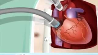 Кардиохирургия   Аорто коронарное шунтирование   Coronary Artery Bypass Graft CABG(, 2016-09-15T23:12:35.000Z)