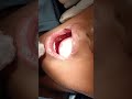 #pedo extraction #milk teeth extraction #teeth removal#dentist #thedentalviews #dentalclinic #teeth