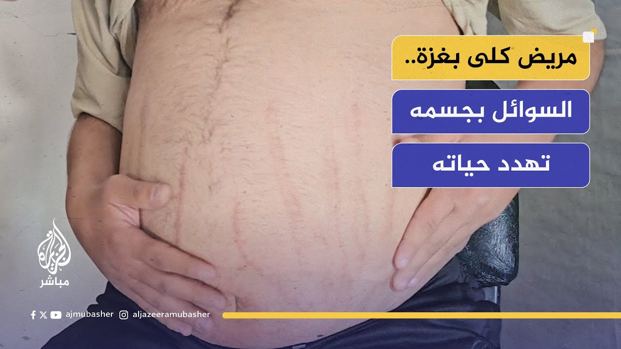 مريض كلى في غزة.. السوائل في جسمه تهدد حياته