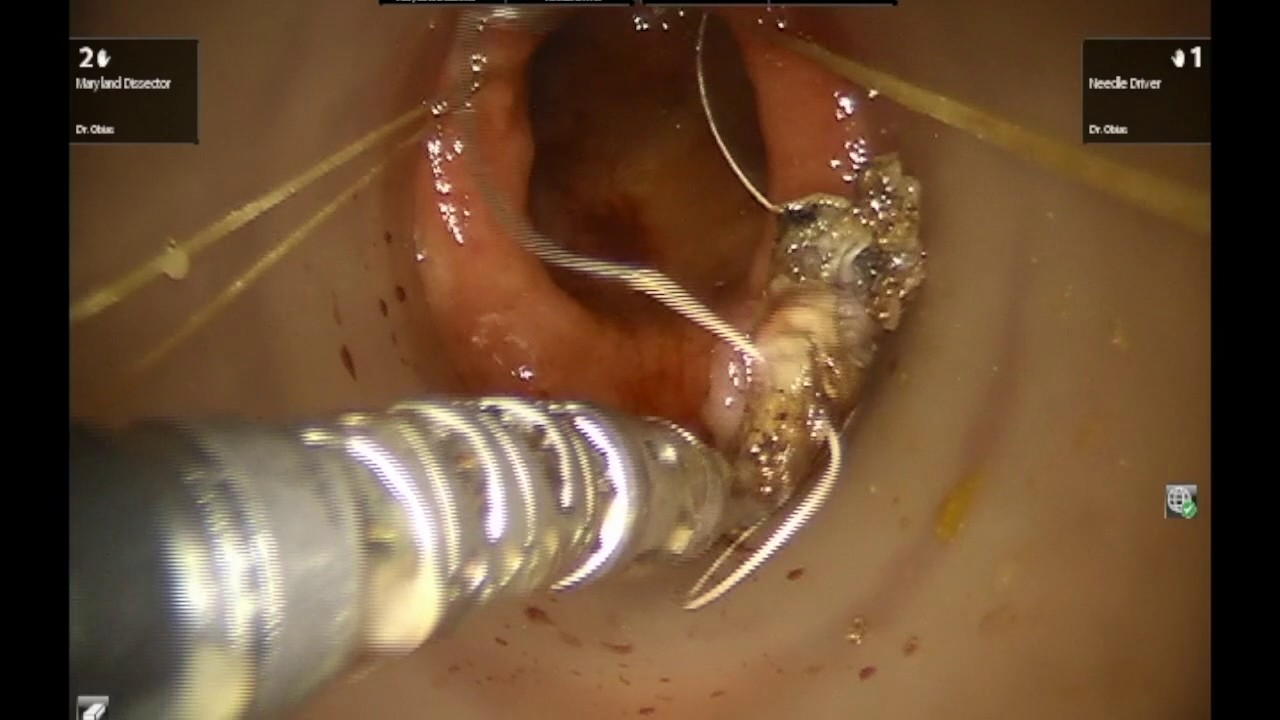 TAMIS Obias Biteman camera iphone 8 plus apk