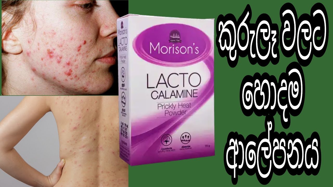 කුරුලෑ වලට හොදම ආලේපනය ලැක්ටෝ කැලමයින් ක්‍රීම් , පවුඩර්,ලෝශන් /lacto calamine for acne face & body