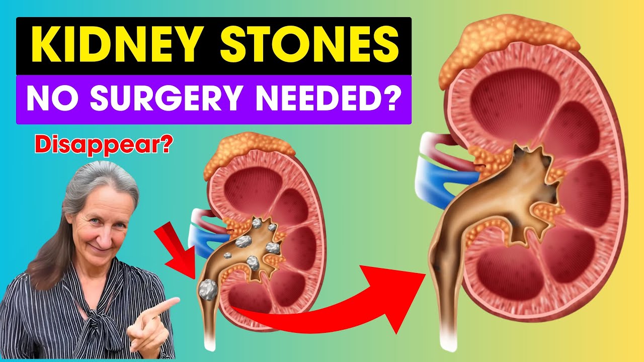 Can KIDNEY STONES Really Disappear On Their Own?