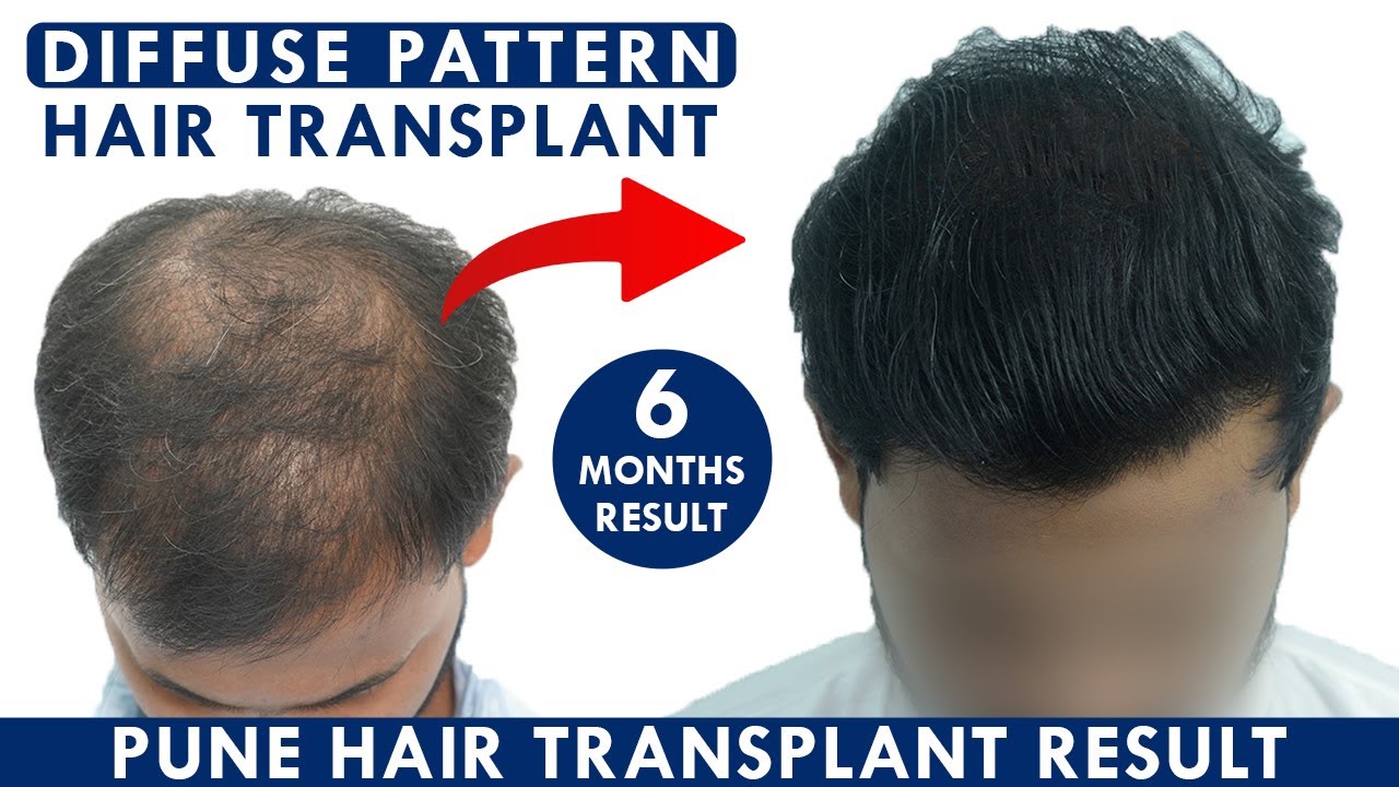 Hair Transplant in Pune Hairmate Clinic Pune Hair Transplant