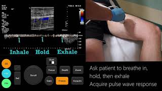 Ultrasound Tutorial  DVT   Lower Limb Veins   Radiology Nation