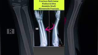 Digital Xray  Child Forearm Xray xray radiographerusn