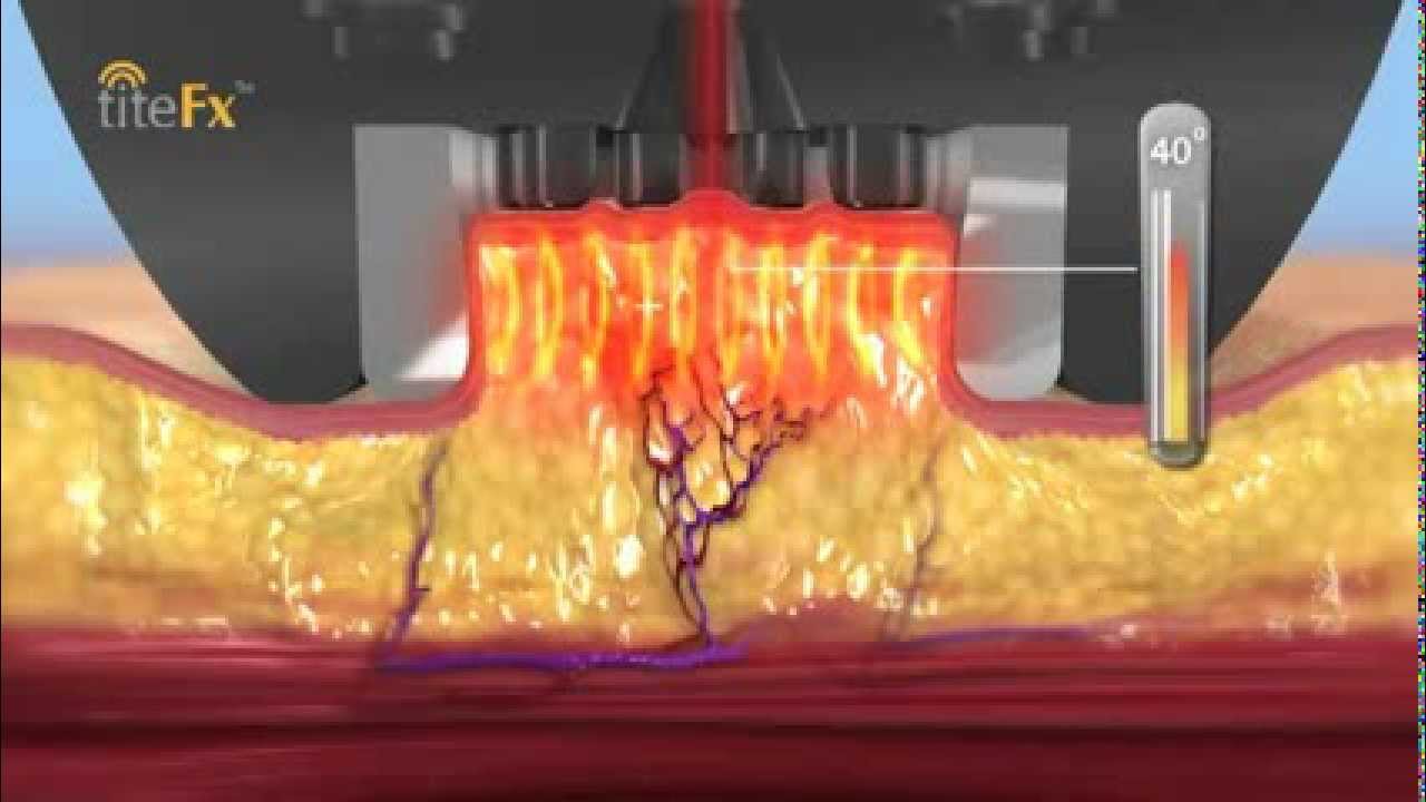 How the BodyTite or TiteFX Laser Gets Rid of Belly Fat