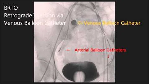 Balloon-occluded Retrograde Transvenous Obliteration for Uterine Arteriovenous Malformation