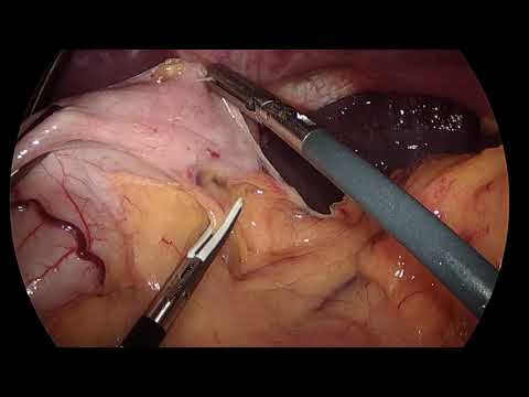 Laparoscopic Sleeve Gastrectomy: Surgical Technique