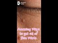 Effective Tips to Remove Skin Warts 🩺