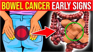 10 Early Warning Signs Of BOWEL CANCER You Should Not Ignore - (Colon Cancer Signs)