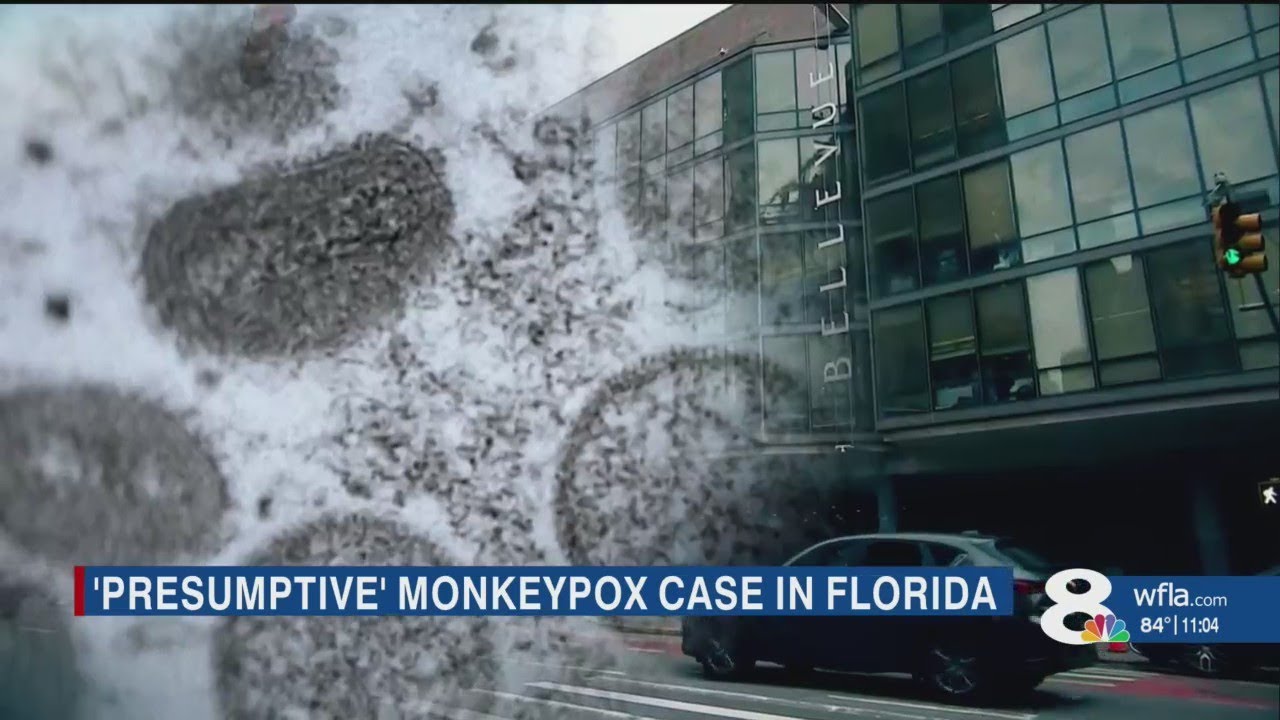 Presumptive case of monkeypox found in South Florida