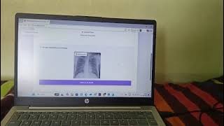 Explainable Tuberculosis Detection from Chest X-Rays using Deep CNN and LLaMA-3 | Data Science  screenshot 1