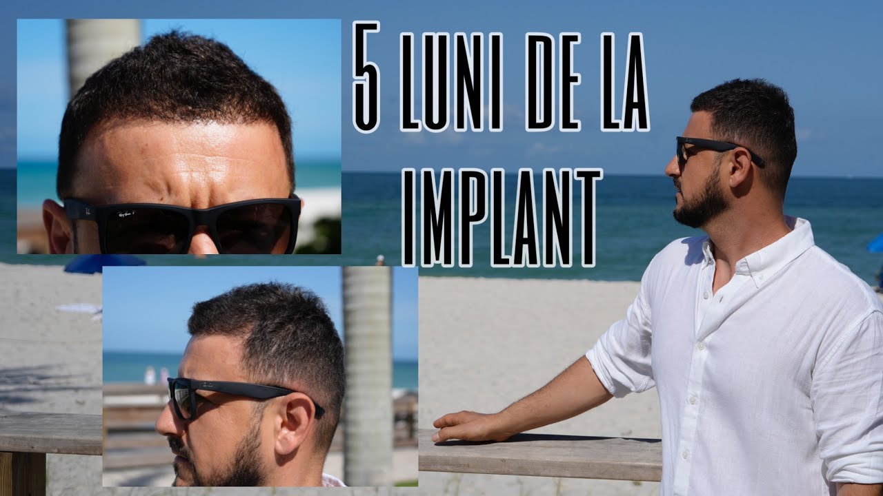 Multumit UPDATE IMPLANT DE PAR LA 5 LUNI, DEZAMAGIT sau MULTUMIT ??? - YouTube