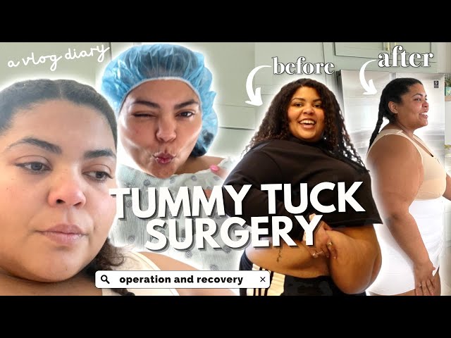 I FINALLY GOT MY PLUS SIZE TUMMY TUCK SURGERY & BRA LINE BACK LIFT VLOG