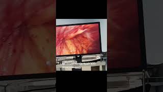 From Hernia to Healing #drbharat #laparoscopy #advancesurgery #ssmghospitalchomu