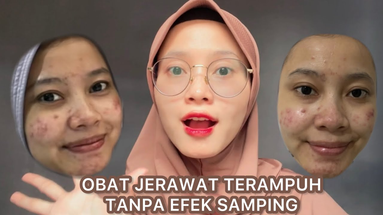 REVIEW ACNE SPOT MS GLOW | Rekomendasi obat jerawat Terampuh