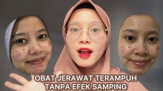 REVIEW ACNE SPOT MS GLOW | Rekomendasi obat jerawat Terampuh