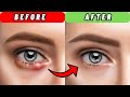 How to get rid of a stye overnight  how to treat a stye on the eye  best way to treat a stye
