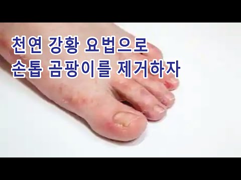 천연 <strong>강황</strong> 요법으로 손톱 곰팡이를 제거하자