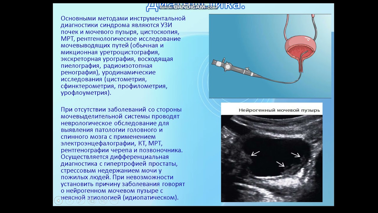 Нейрогенный мочевой у мужчин. Нейрогенный мочевой пузырь на УЗИ. Протектор слизистой мочевого пузыря. Препараты для гиперактивного мочевого пузыря. Малый мочевой пузырь нейрогенный.