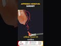 Dont Ignore Severe Abdominal Pain:It Could Be Appendicitis | Maa and Family Multispecialty Hospital