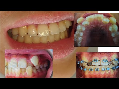 Before and after: A patient's braces story: 18 months