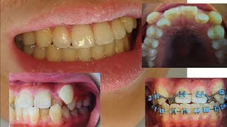 Patient Braces Testimonial - Before & After Braces Results