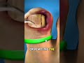Ingrown Toenail Surgery Animation | 3D Medical Procedure! #shorts #shortsfeed #ytshorts #yt