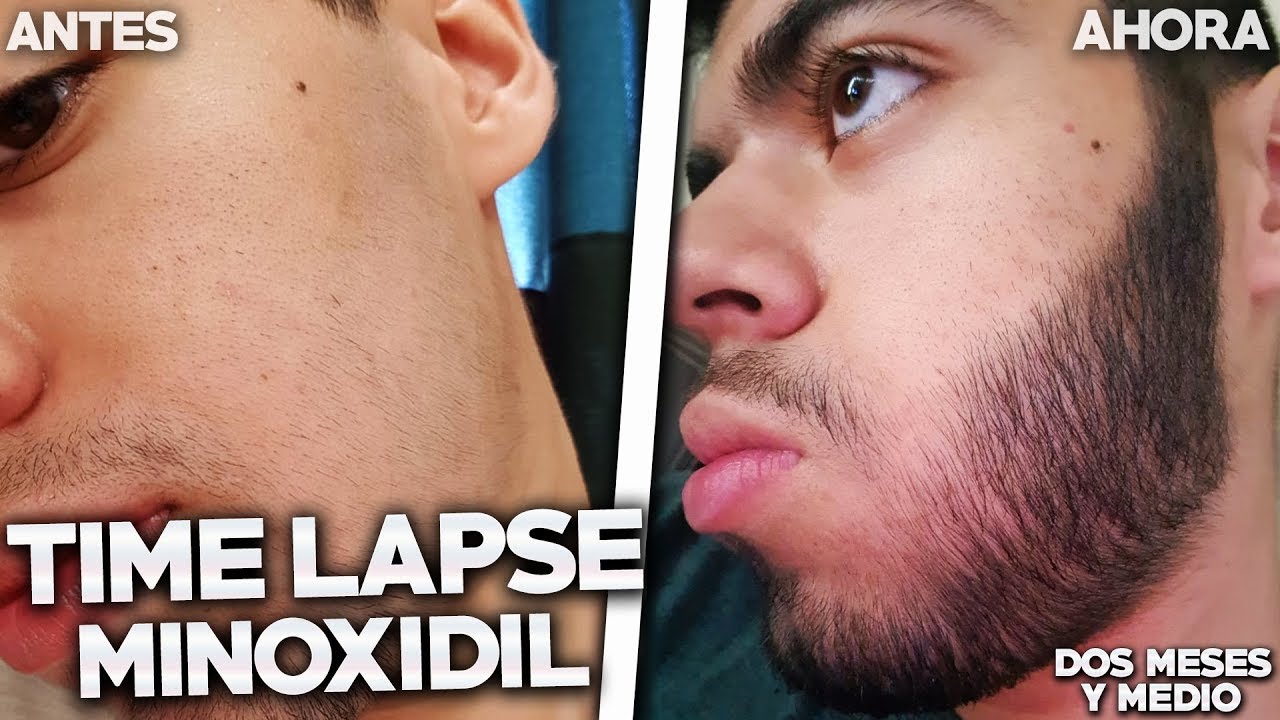 TIME LAPSE DE MINOXIDIL 2 MESES Y MEDIO