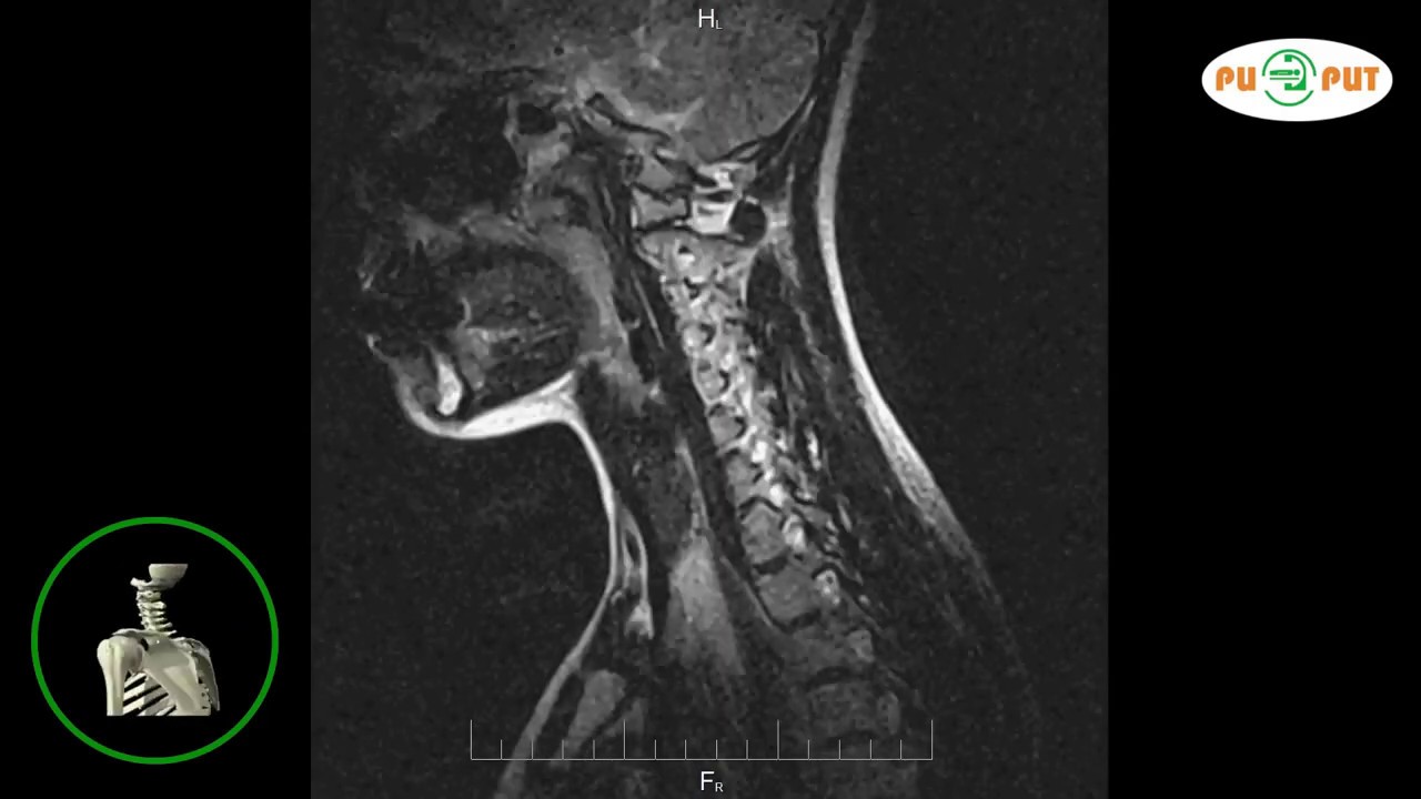 Мрт шейного отдела позвоночника по времени. Магнитно-резонансная томография шейного отдела позвоночника. Снимки мрт шейного отдела. Мрт шейного отдела позвоночника. Мрт шейного отдела позвонка.