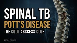 Spinal Tuberculosis — Pott’s Disease Explained